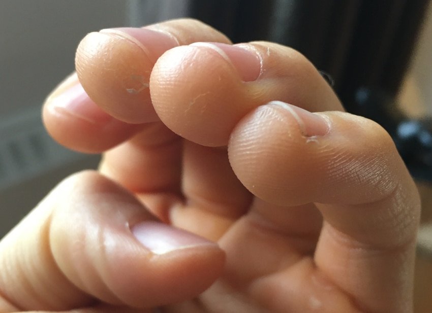 Calluses